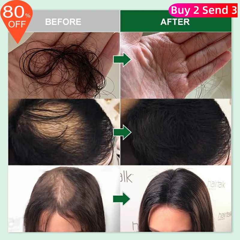 Rosemary Oil Hair Growth Products Ginger Anti Loss Fast - BrandedPieces' shop